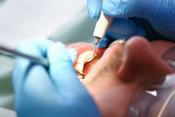 Best Emergency Dentist for Lost Fillings or Crowns in Charleston, SC